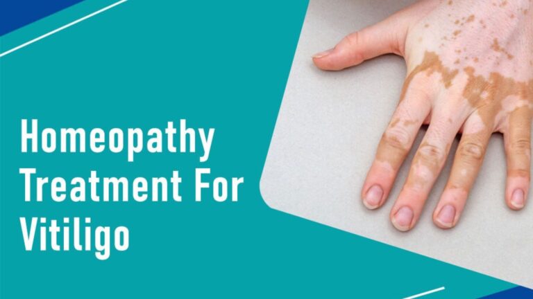 All About Vitiligo: You Need To Know
