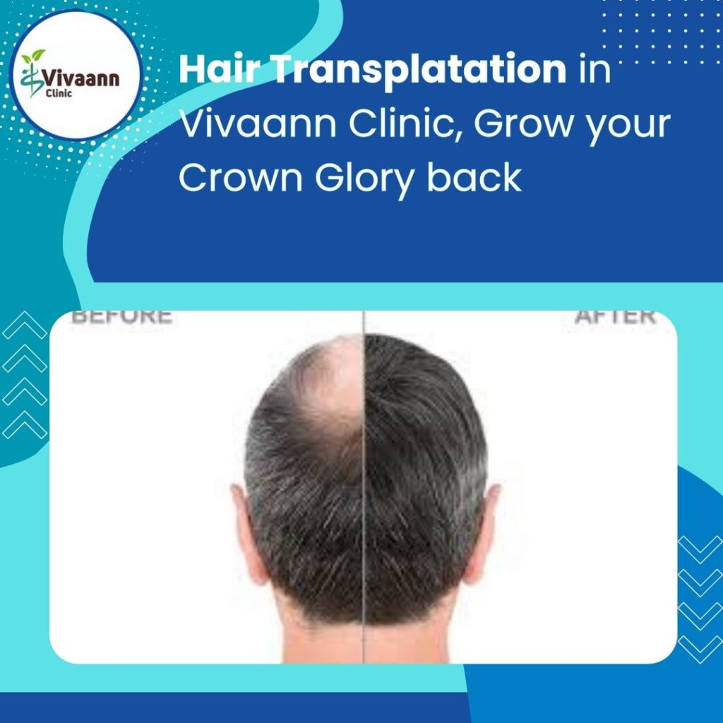 Hair transplant