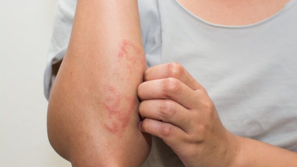 Skin Allergy img