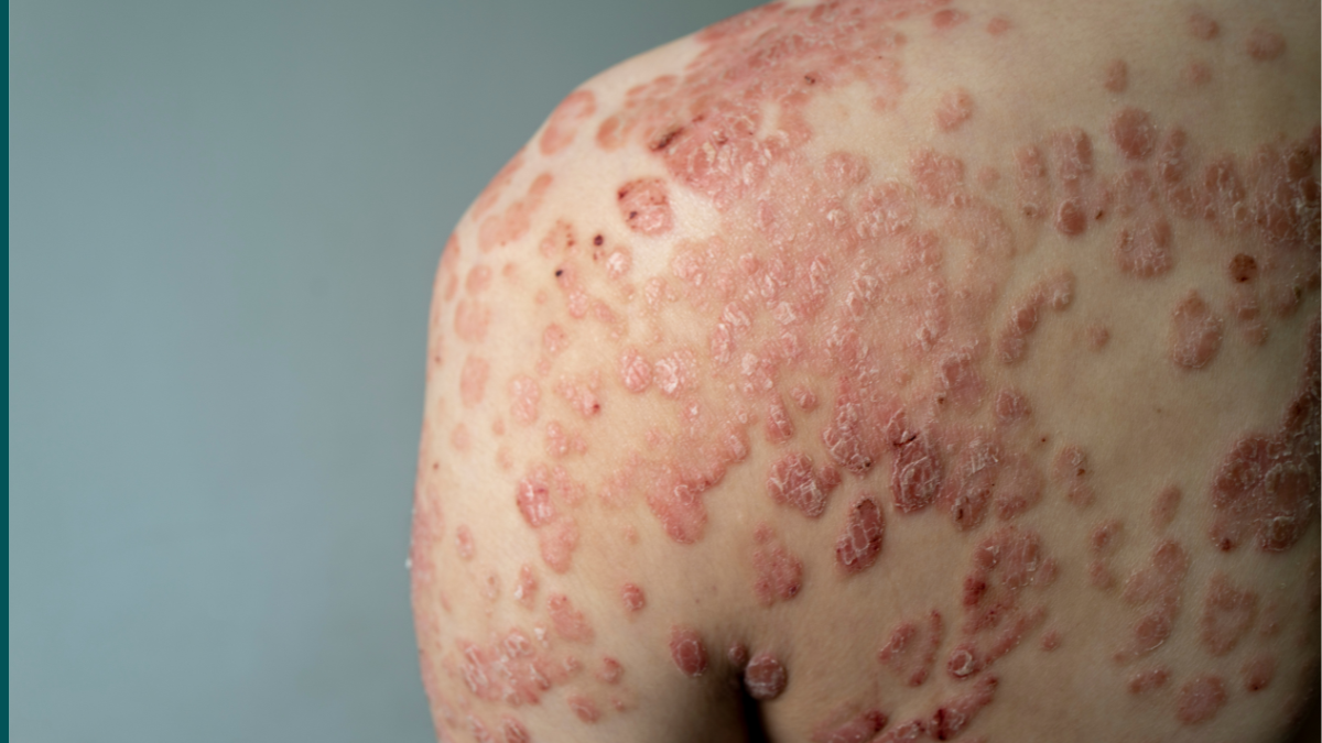 Psoriasis: Why It Keeps Coming Back After Every Treatment